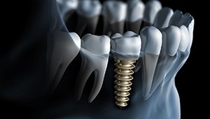 Single dental implant in Phoenix, AZ in lower jaw