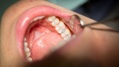 Patient's smile examined after filling placement