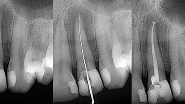Root Canal Infection Xray