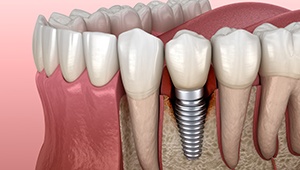 Woman with jaw pain from failed dental implant