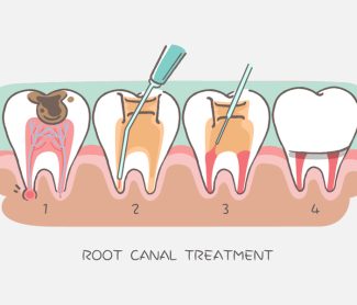 How Cavities Start and Stop Them Fast